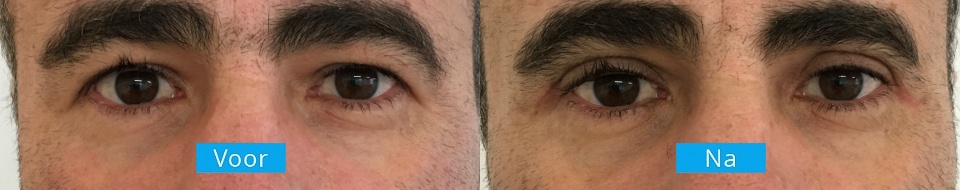 Ooglidcorrectie-voor-na-3 Ooglidcorrectie voor en na behandeling man
