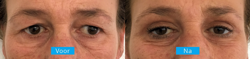 Ooglidcorrectie voor na 4 Ooglidcorrectie voor en na behandeling 4