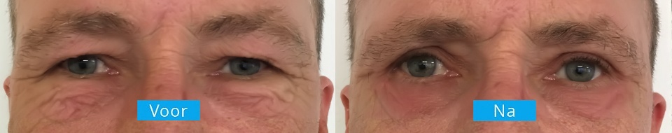 Ooglidcorrectie-voor-na-mannen Ooglidcorrectie voor en na behandeling mannen